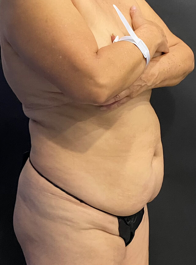 Case--2459 | Before Tummy Tuck 2