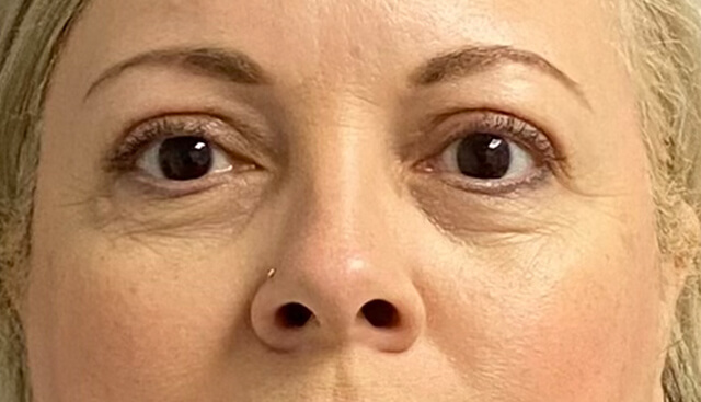Case--9342 | After Upper Blepharoplasty