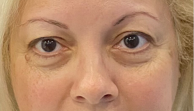 Case--9342 | Before Upper Blepharoplasty