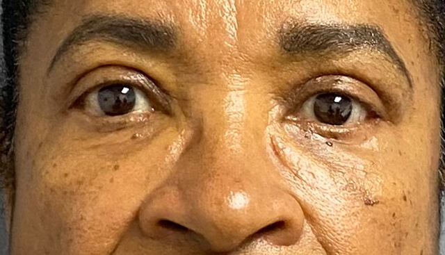 Case--4543 | After Upper Blepharoplasty