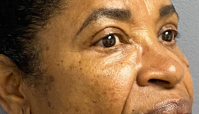 Case--4543 | After Upper Blepharoplasty 2