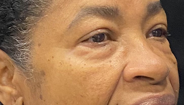 Case--4543 | Before Upper Blepharoplasty 2