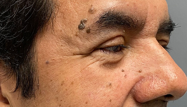 Case--7214 | After Upper Blepharoplasty 2