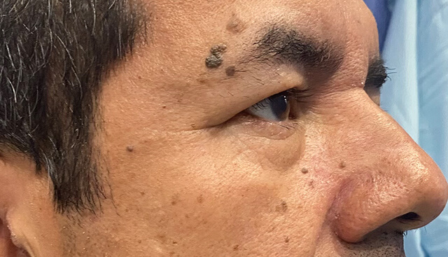 Case--7214 | Before Upper Blepharoplasty 2