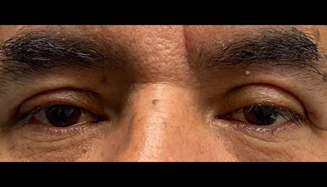Case--7214 | After Upper Blepharoplasty