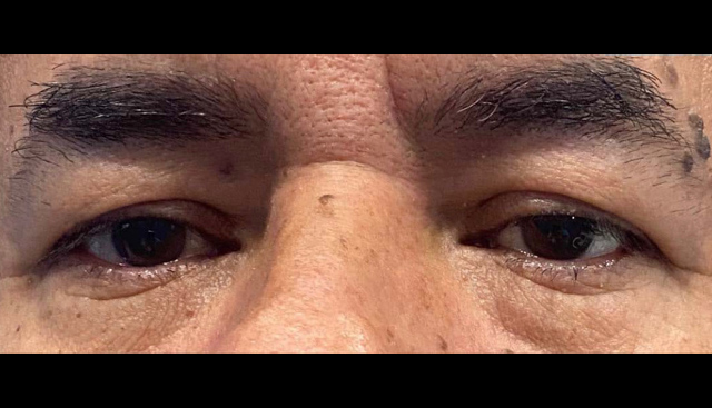 Case--7214 | Before Upper Blepharoplasty