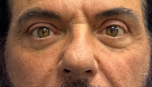 Case--7956 | After Upper Blepharoplasty