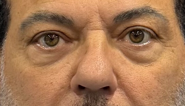 Case--7956 | Before Upper Blepharoplasty