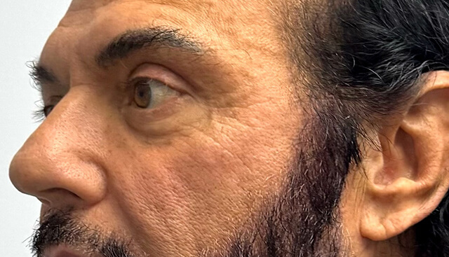 Case--7956 | After Upper Blepharoplasty 2