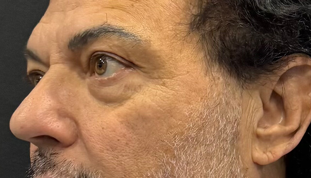 Case--7956 | Before Upper Blepharoplasty 2