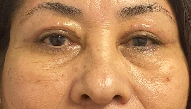 Case--9384 | After Upper Blepharoplasty