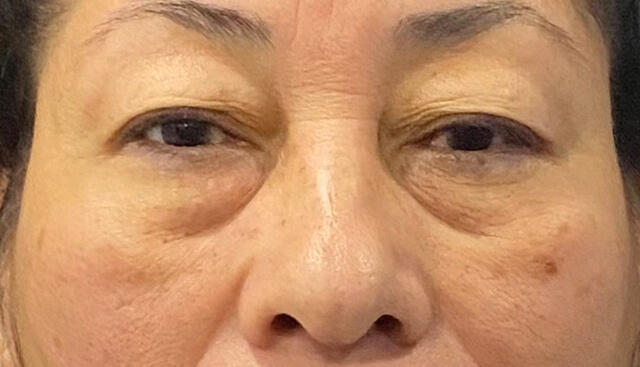Case--9384 | Before Upper Blepharoplasty