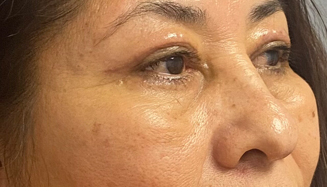 Case--9384 | After Upper Blepharoplasty 2