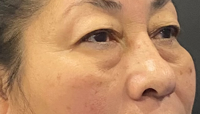 Case--9384 | Before Upper Blepharoplasty 2